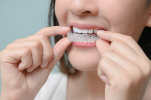 Woman putting clear aligners over teeth